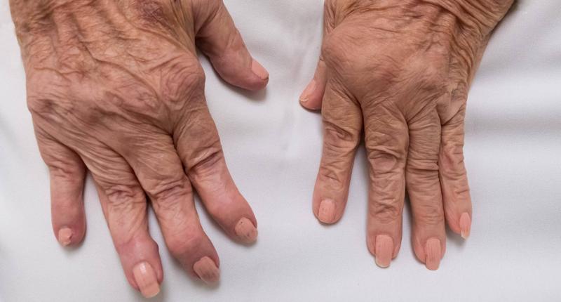 Reumatyzm odżywianie