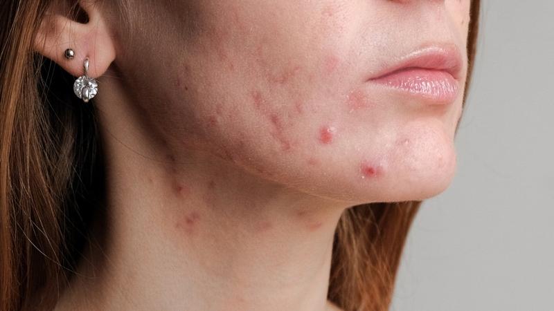 Bakterie na skórze i higiena