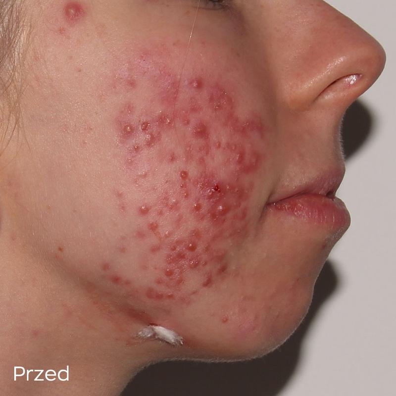 Jak dotykanie twarzy wpływa na trądzik i zdrowie cery?