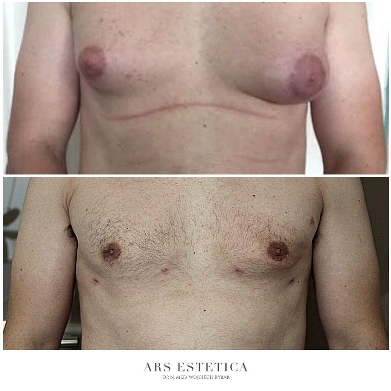 Jak skutecznie rozpoznać ginekomastię i nie pomylić jej z innymi schorzeniami?