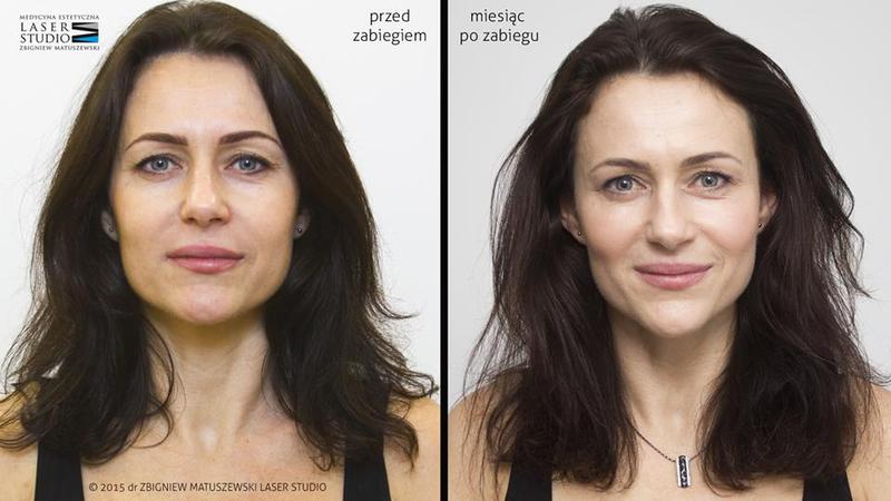 Ćwiczenia i joga twarzy