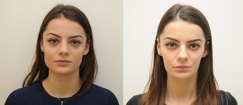 Skuteczne sposoby na schudnięcie z twarzy